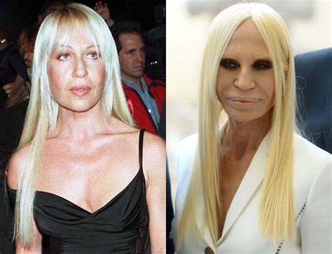 donatella versace vende|donatella versace before and after surgery.